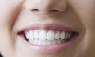 إكتشاف إرتباط بين فقدان الأسنان وزيادة خطر السمنة image